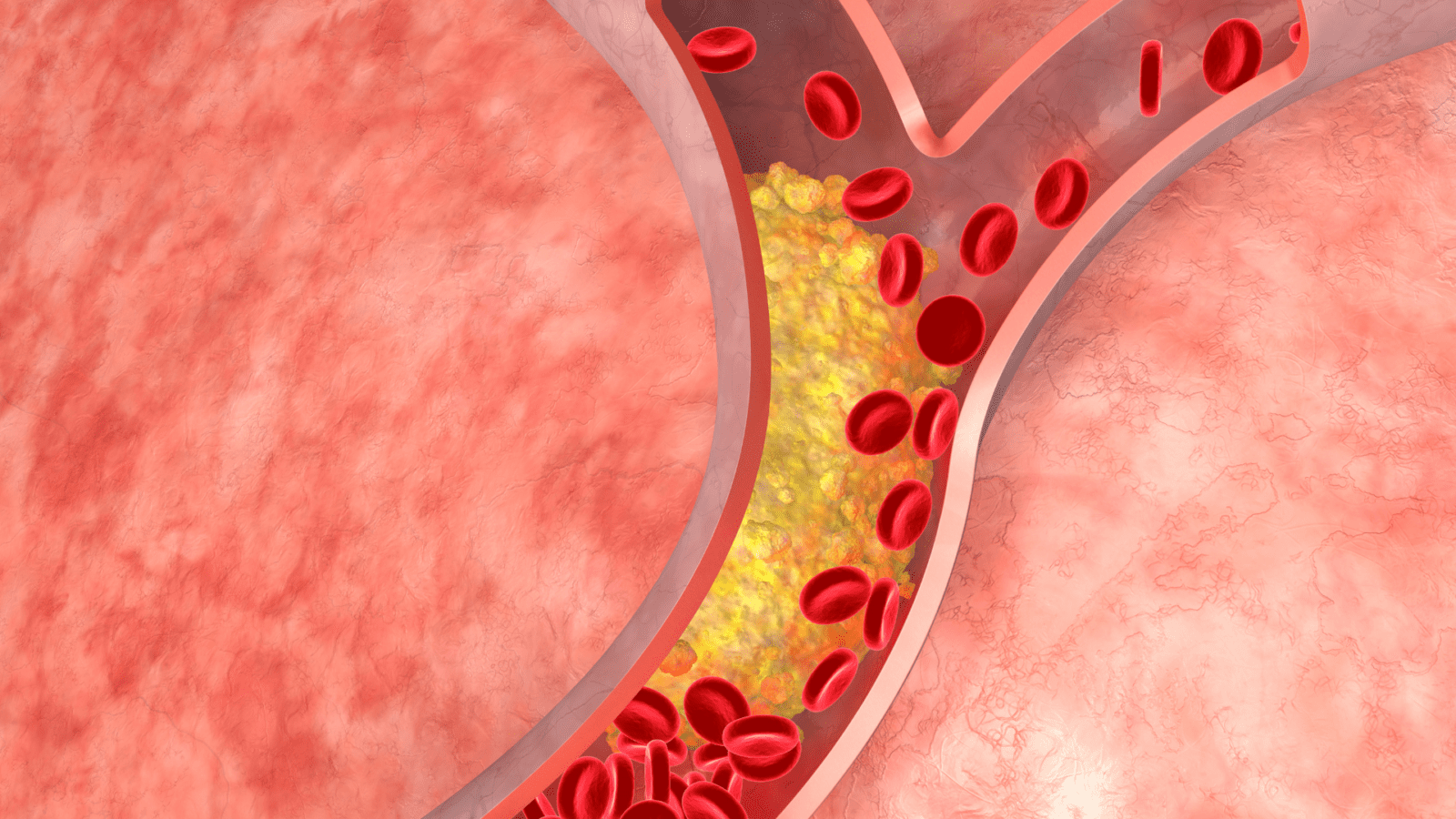 Calcium in arteries